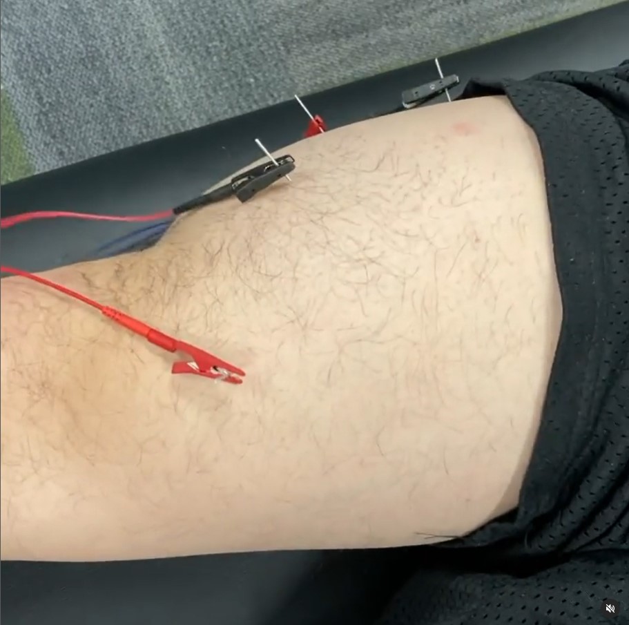 What Are The Types Of Dry Needling? How Electrical Stimulation Can Help 