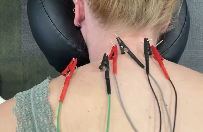 Electrical Stimulation - RXR Rehab Physical Therapy